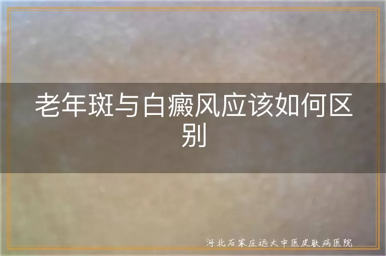 白斑是老年斑还是白癜风辨别,老年斑与白癜风区别一看就懂,皮肤白斑怎么区分老年斑白癜风