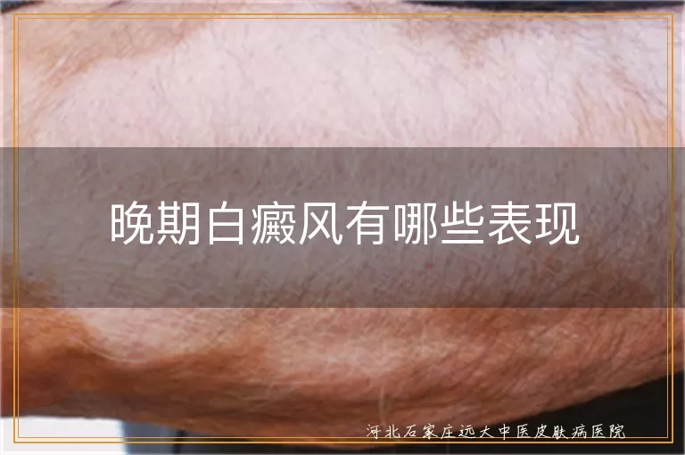 晚期白癜风皮肤症状有哪些,白斑晚期的主要表现是什么,白癜风发展到后期会怎样
