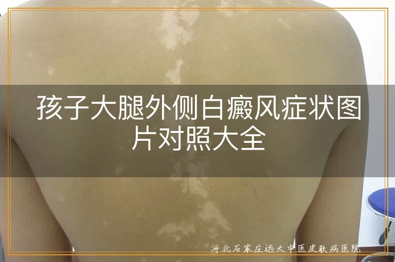 大腿外侧白斑是白癜风吗图片,儿童大腿白癜风初期照片大全,小孩腿外侧长白斑图片参考