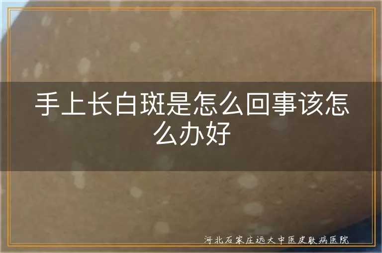 手上长白斑是白癜风吗怎么办,手部白斑的原因与解决方法,手上出现白斑怎么处理什么病