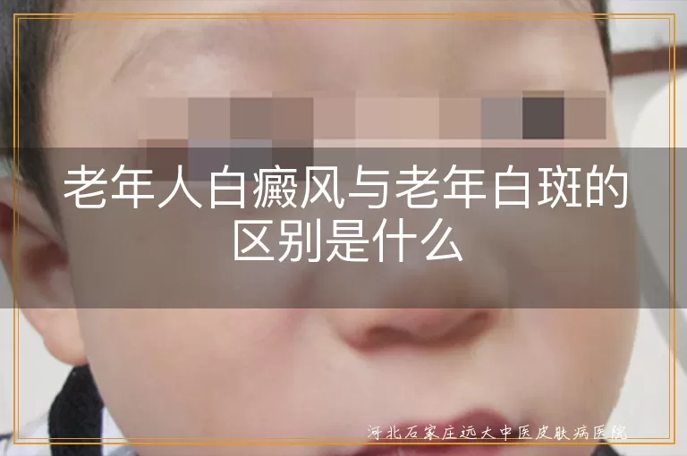 老年人白癜风与老年白斑的区别是什么