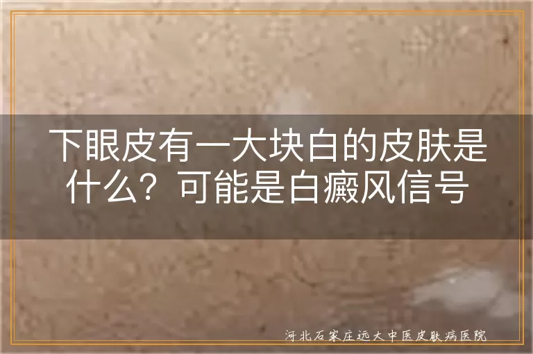 下眼皮白斑是白癜风吗?一大块白皮肤原因,眼皮长白斑怎么回事?下眼睑白癜风症状,下眼皮一大块白皮肤,警惕早期白癜风白斑