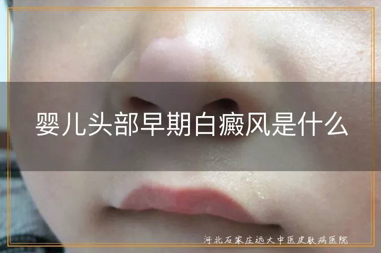 婴儿头部早期白癜风是什么