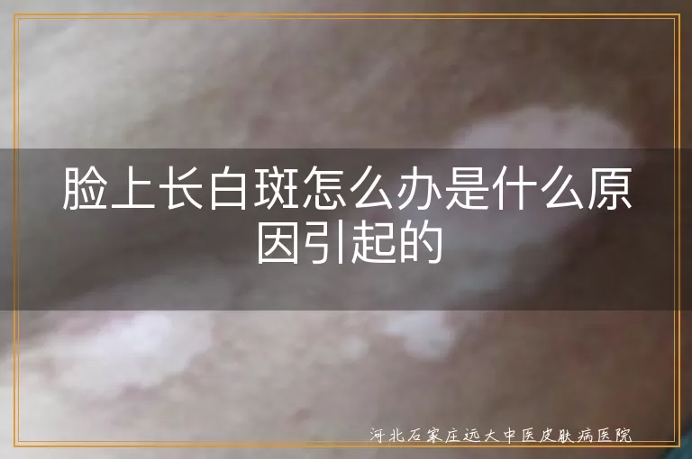 脸上有白斑怎么回事怎么解决,脸上白斑是不是白癜风,脸上长白斑的原因和处理方式