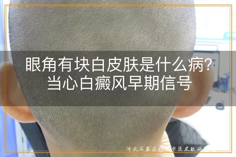 眼角白斑小心是白癜风征兆,眼部白块警惕白癜风早期表现,眼角皮肤变白可能与白癜风有关