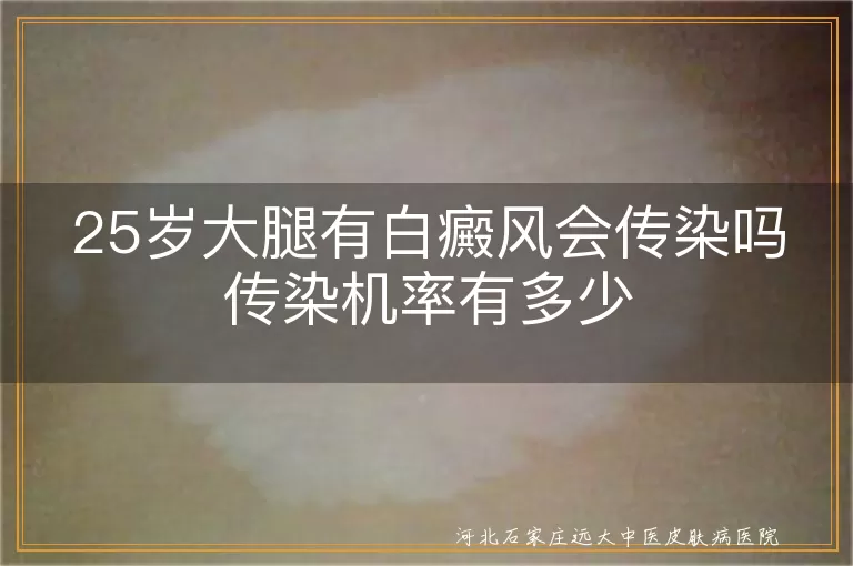 大腿白癜风会不会传染,25岁大腿白斑传染几率,白癜风白斑会传染人吗
