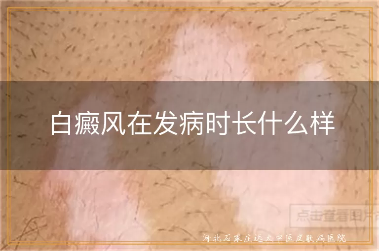 白癜风刚开始发病时皮肤长什么样,身上出现白斑是什么样子图片,白癜风早期外观表现有哪些