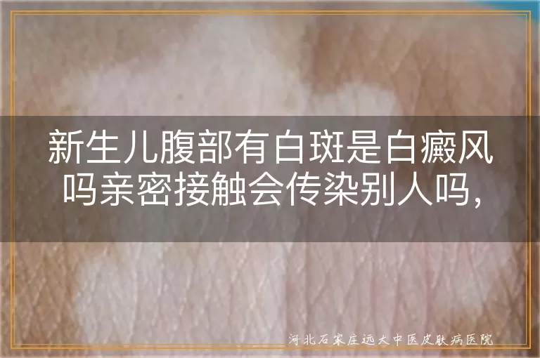 新生儿腹部有白斑是白癜风吗亲密接触会传染别人吗,宝宝肚皮长白斑确诊白癜风日常接触会被传染吗,婴儿腹部白癜风和白斑亲密接触到底会不会传染人