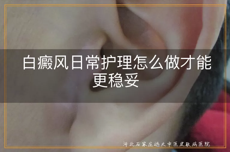 白癜风日常护理怎么做才能更稳妥