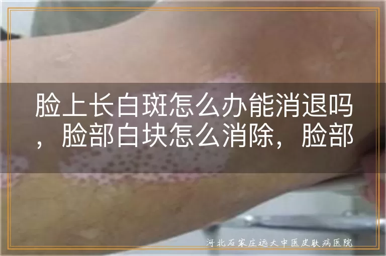 脸部有白块咋办能祛除吗,脸上长白斑怎么办能消退吗,脸部白块怎么消除,白癜风脸部白斑能好吗,白斑在脸上如何去掉