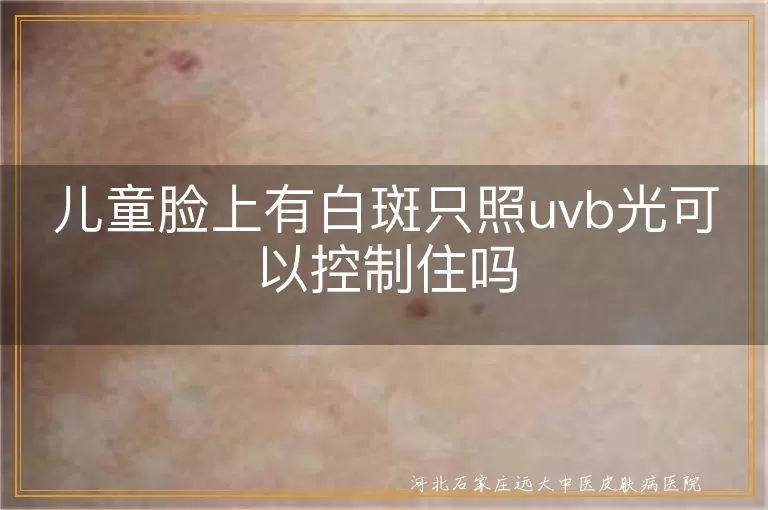 儿童面部白点只照uvb能控制吗,小孩脸上有白斑照uvb管用吗,孩子面部白斑单用uvb行不行