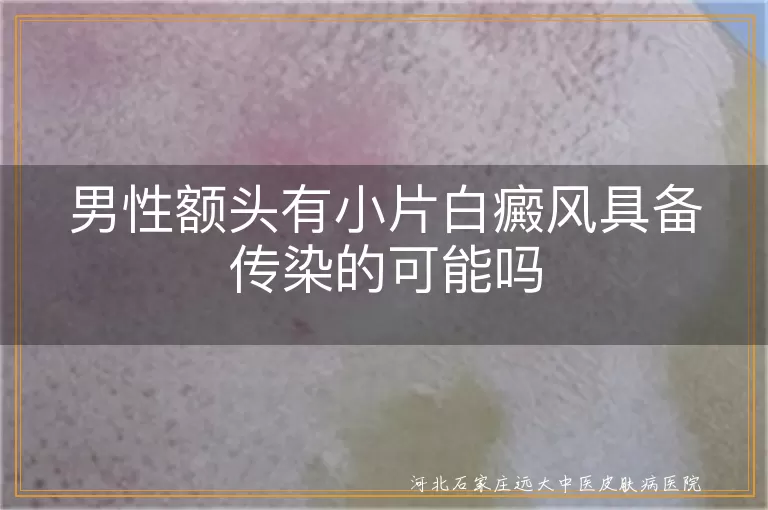 男性额头白斑会传染别人吗,男性额头白癜风有没有传染性,额头小片白斑会传给别人吗