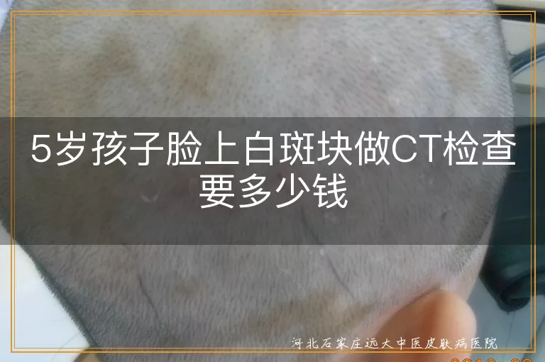 5岁孩子脸上白斑块做CT检查要多少钱