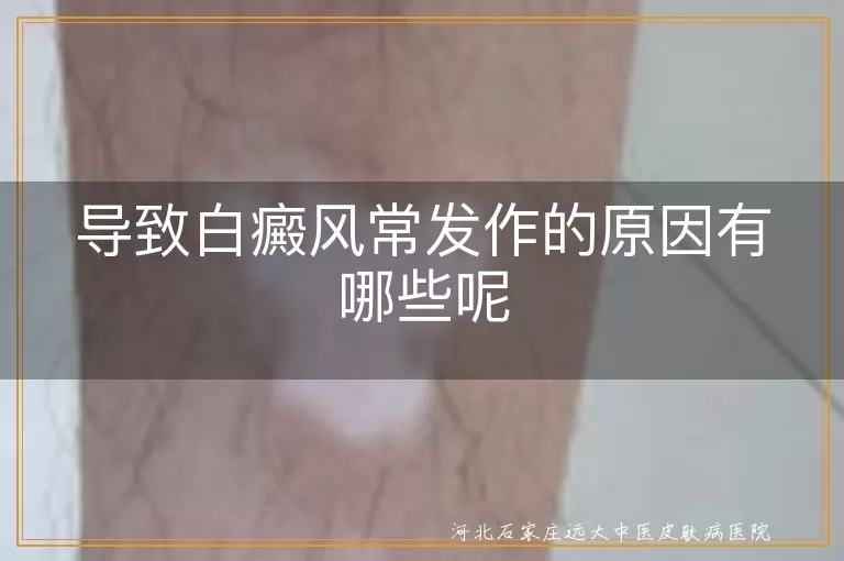 白癜风反复发作的原因有哪些,白斑经常出现是什么原因,导致白癜风常发作的诱因是什么