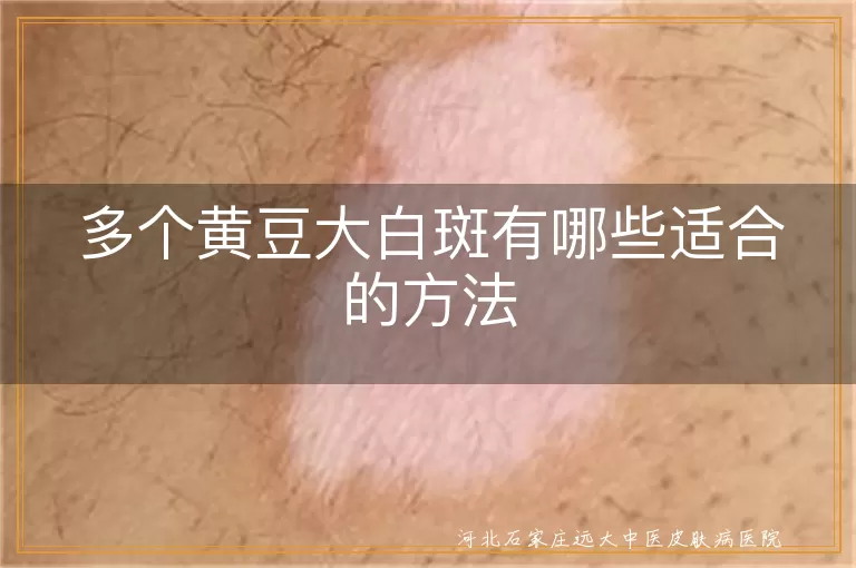 多个黄豆大白斑有哪些适合的方法