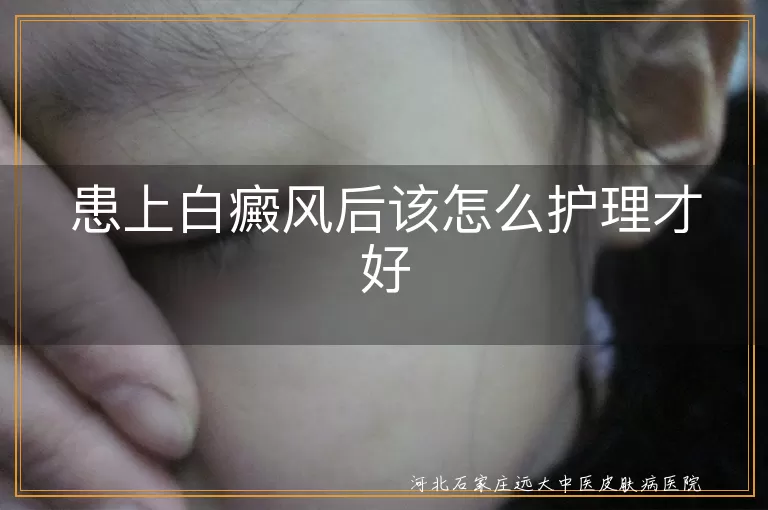 白癜风日常护理方法,白斑出现后怎么护理,得了白癜风如何正确护理