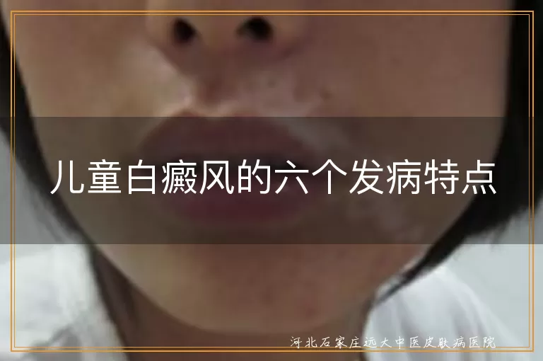儿童白癜风的六个发病特点