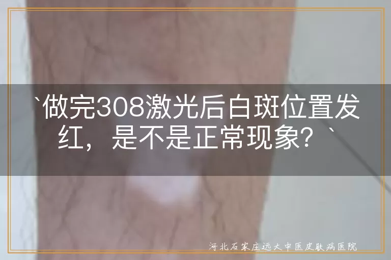 `308激光治疗`,`白斑`,`发红`,`正常反应`,`异常情况`,`医生操作`,`过敏反应`