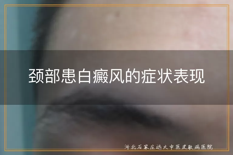 颈部白癜风,皮肤颜色改变,白斑,瘙痒,毛发脱落,科学治疗,护理工作