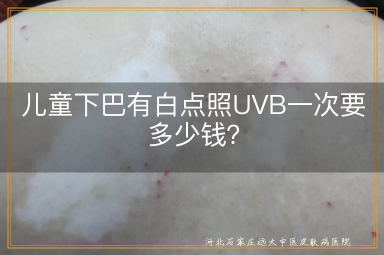 UVB光疗,儿童下巴白点,价格,医院级别,治疗周期