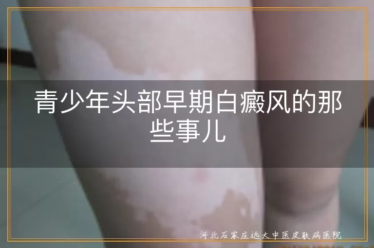 青少年,头部,早期白癜风,症状,原因,治疗,生活习惯,心理健康