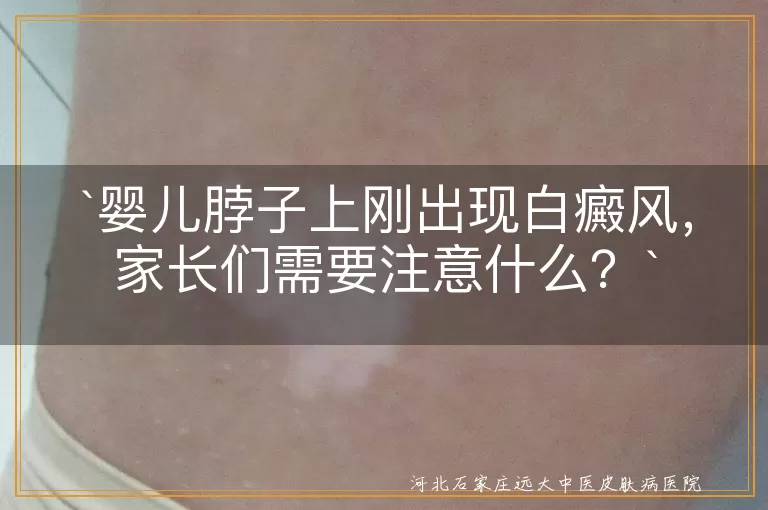 `婴儿白癜风,脖子白斑,遗传因素,免疫因素,环境因素,及时就医,观察变化,防晒,皮肤清洁,饮食调理,治疗方法,预防措施`