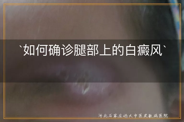 白癜风,腿部白斑,皮肤镜检查,伍德灯检查,组织病理学检查,确诊,治疗