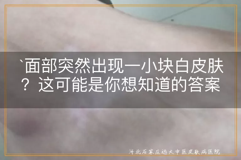 面部白块,白色糠疹,白癜风,皮肤保湿,防晒,饮食习惯,生活习惯,心情愉快