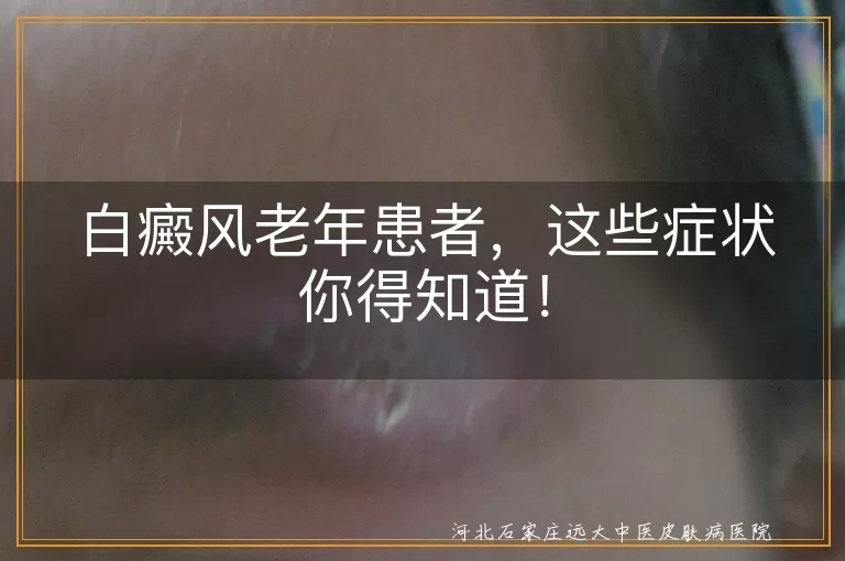 白癜风,老年患者,白斑,扩散,伴随症状,心理影响,并发症,治疗反应