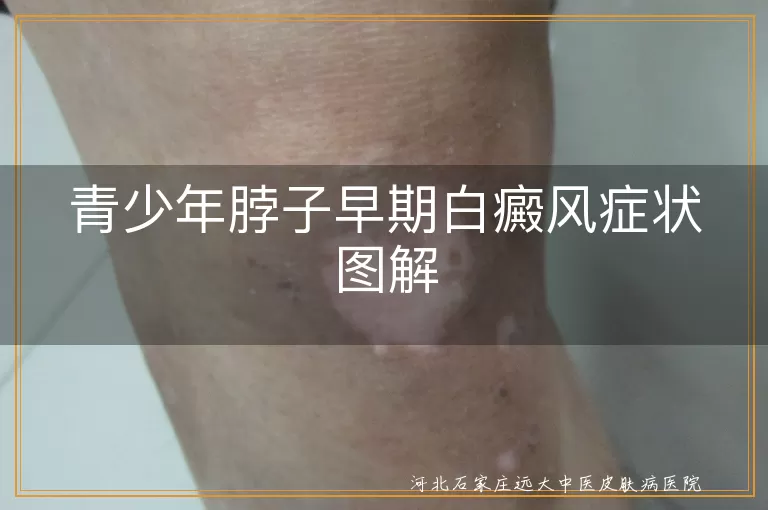 青少年,脖子,早期白癜风,症状,治疗