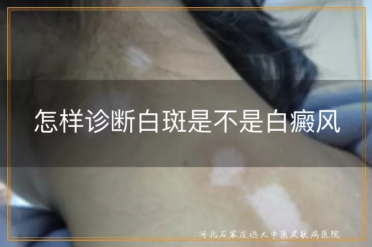 白癜风,白斑,皮肤颜色,症状,专业检测,病程,发病部位,就医