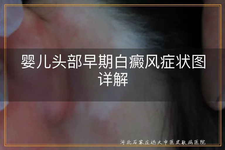婴儿头部,白癜风,早期症状,白斑,伍德灯检查,治疗策略,日常护理,心理关怀