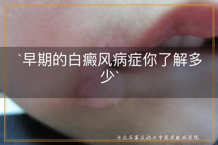 白癜风,早期症状,白斑,毛发变白,治疗,预防