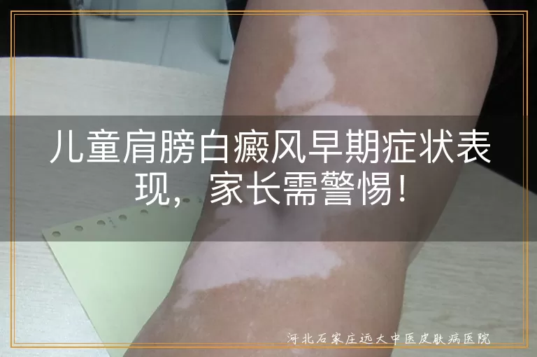 儿童白癜风,肩膀,早期症状,皮肤颜色改变,白斑,就医治疗,心理健康