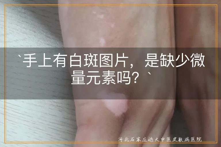白斑,微量元素,皮肤健康,生活习惯,医生诊断