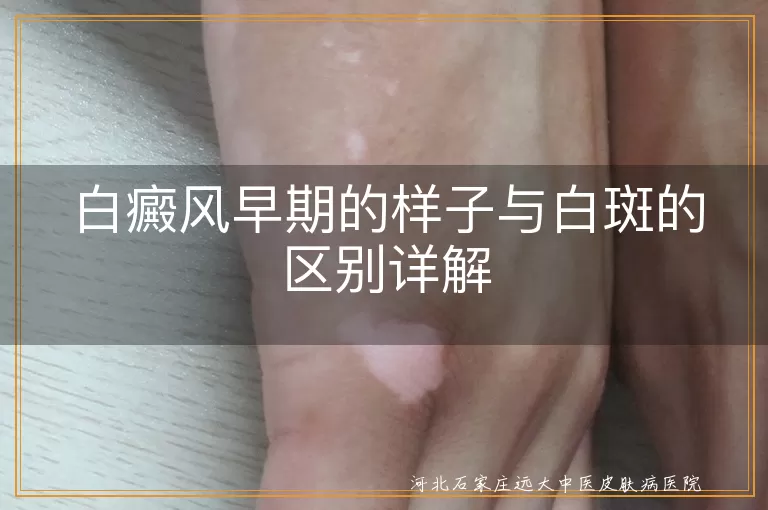 白癜风,早期症状,白斑,区别,治疗