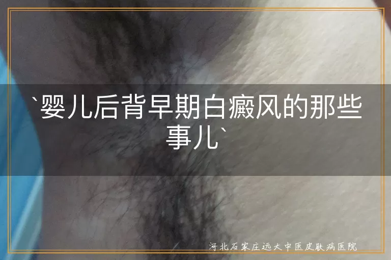 婴儿,后背,早期白癜风,症状,治疗,护理,心理因素,就医检查