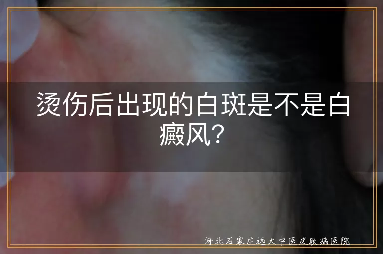 烫伤,白斑,白癜风,色素脱失,花斑癣,皮肤护理,防晒