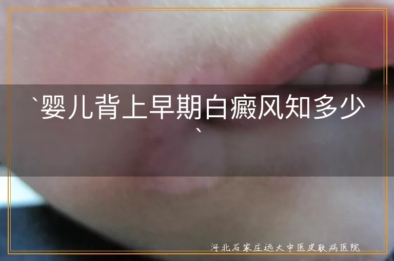 婴儿,白癜风,早期症状,治疗,防晒,生活习惯