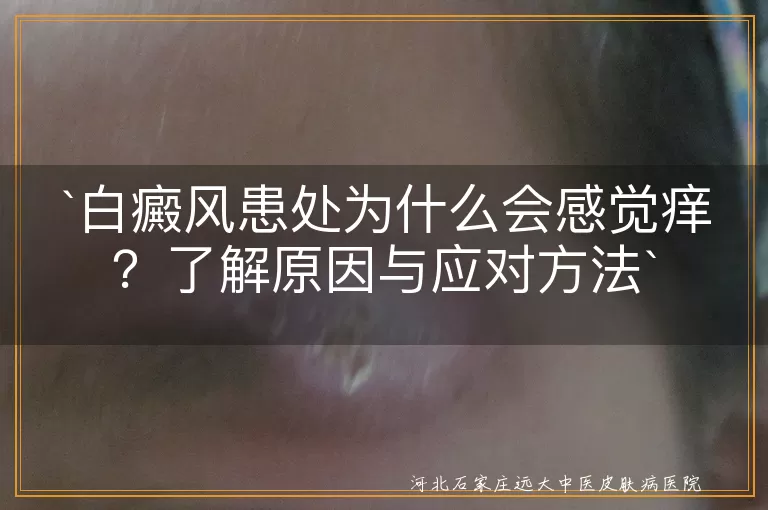 白癜风,患处发痒,皮肤干燥,外界刺激,药物过敏,合并疾病,心理调节