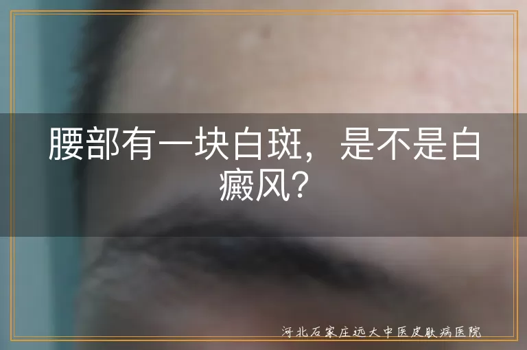 腰部白斑,白癜风,无色素痣,花斑癣,治疗方法,生活习惯