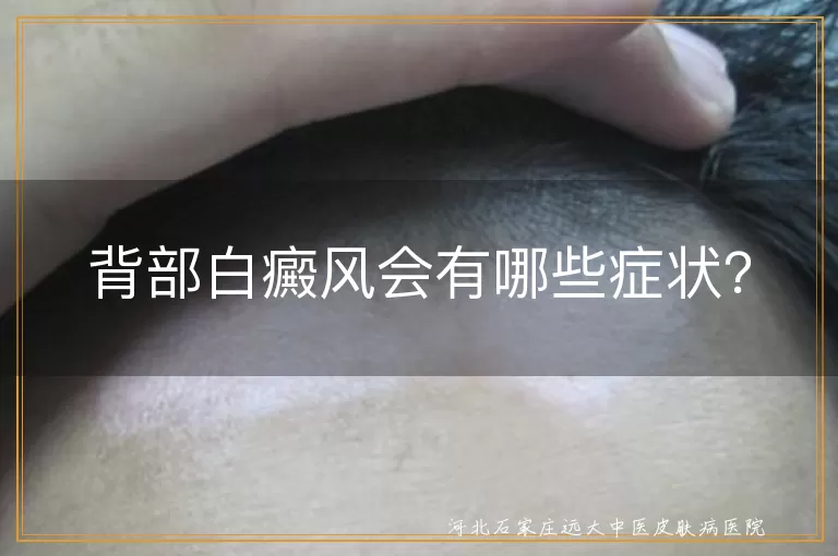 背部白癜风,白斑,毛发变白,紫外线敏感,治疗,防晒,保湿