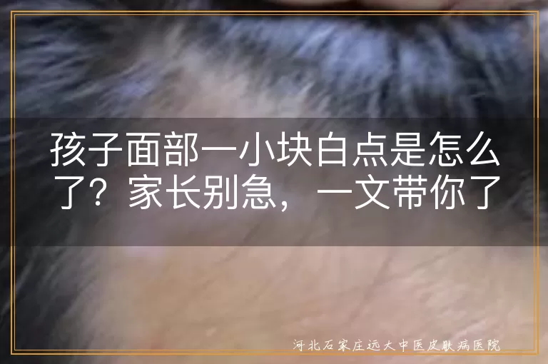 孩子面部,小白点,粟丘疹,白色糠疹,无色素痣,贫血痣,白癜风,日常护理,专业意见