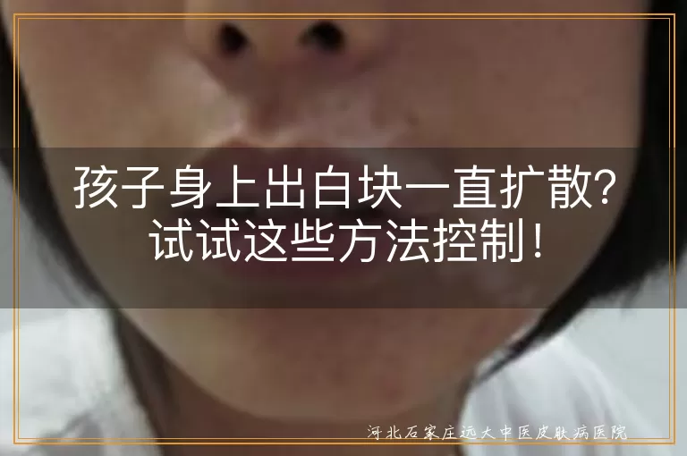 孩子白块,白癜风,白色糠疹,维生素C缺乏,防晒,饮食调整,药物治疗,日常护理