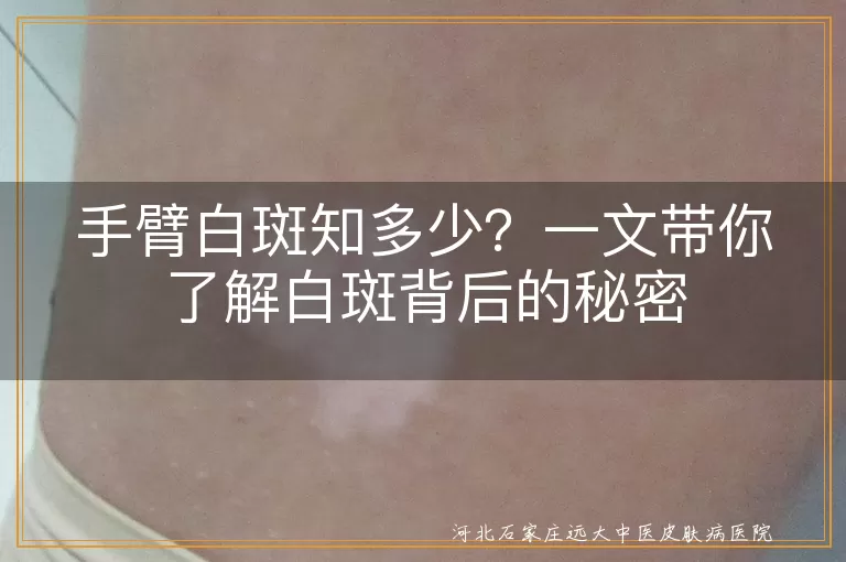 手臂白斑,白癜风,花斑癣,贫血痣,白色糠疹,预防,治疗
