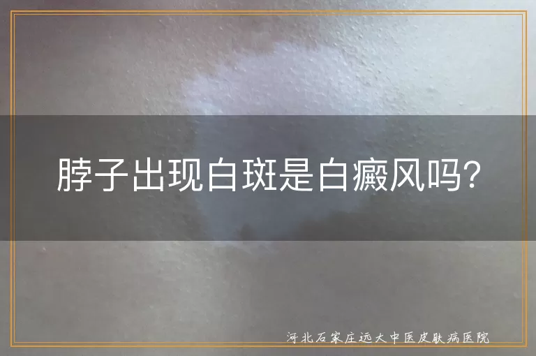 白斑,白癜风,诊断,治疗,日常护理
