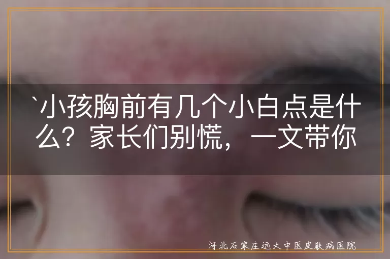 `小孩胸前小白点`,`皮肤问题`,`粟丘疹`,`花斑癣`,`白色糠疹`,`贫血痣`,`观察`,`清洁`,`饮食`,`就医`,`预防`