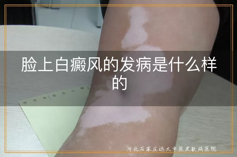 脸上白癜风,乳白色斑块,病情发展,治疗方法,日常护理