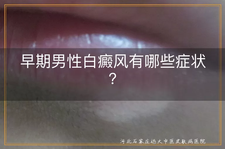早期男性白癜风有哪些症状？