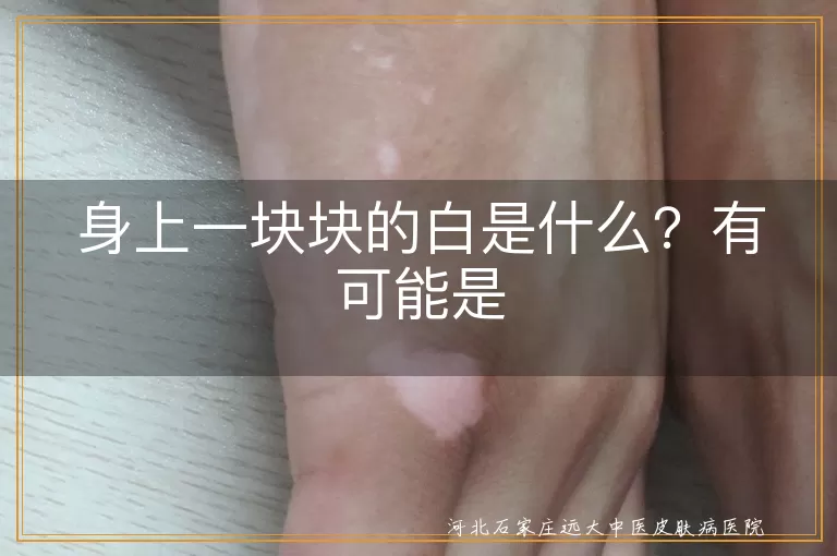 白斑,白癜风,皮肤疾病,白色糠疹,花斑癣,无色素痣,贫血痣,预防,治疗